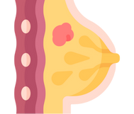 Breast Nodules