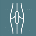 Angioplasty