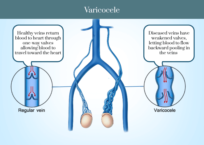 Varicocele Embolization