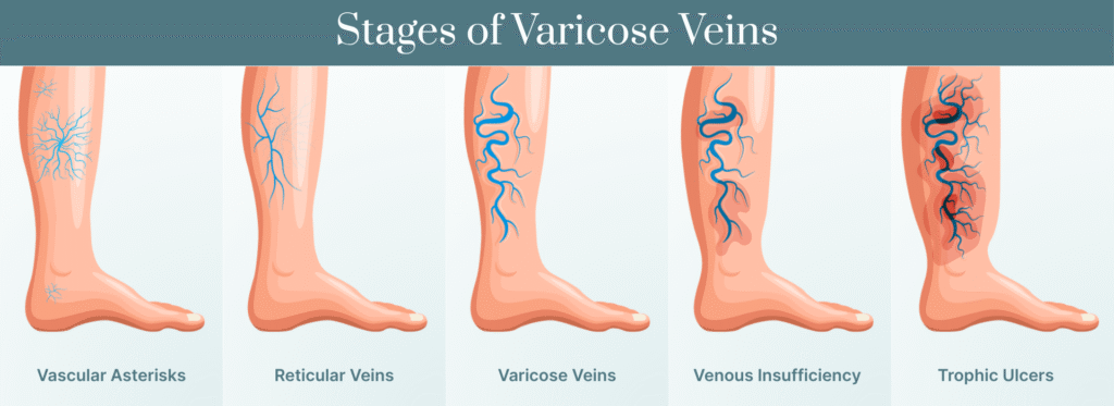 Stages of Varicose Veins
