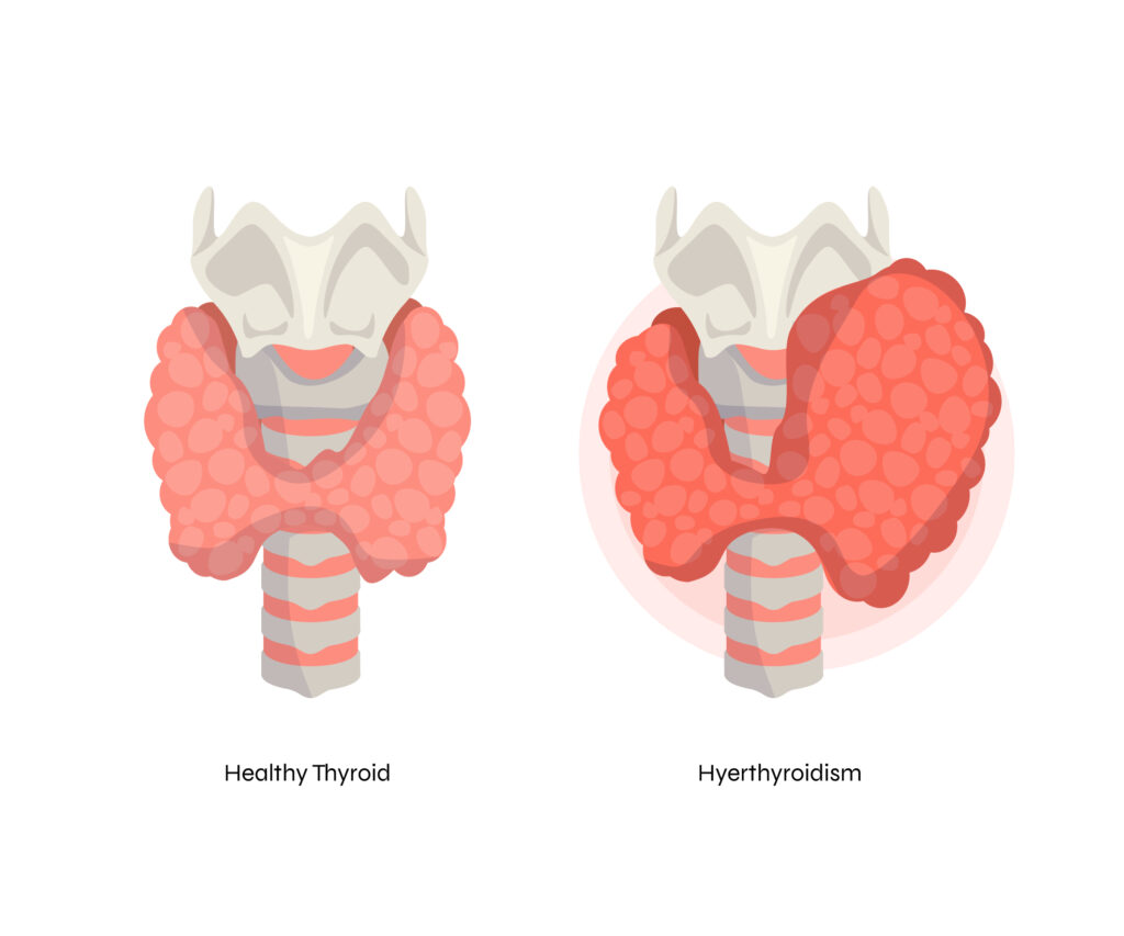Thyroid_Nodules