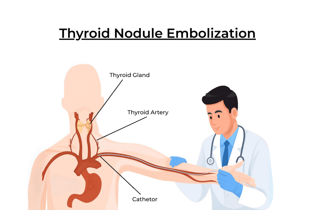 Thyroid_Nodule_Embolization