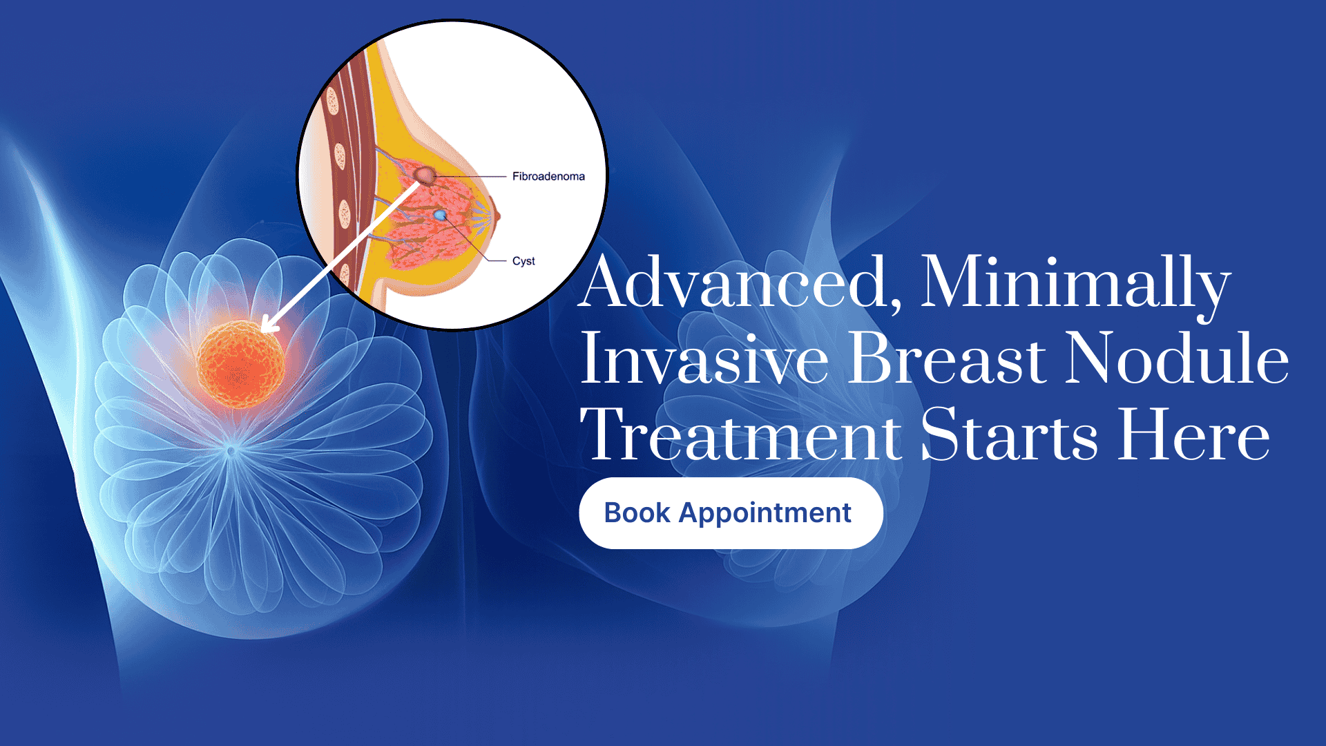 Breast Nodules Treatment